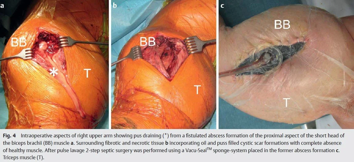Intraoperative aspects of right upper arm showing pus draining (irreversible muscle damage in bodybuilding ).jpg