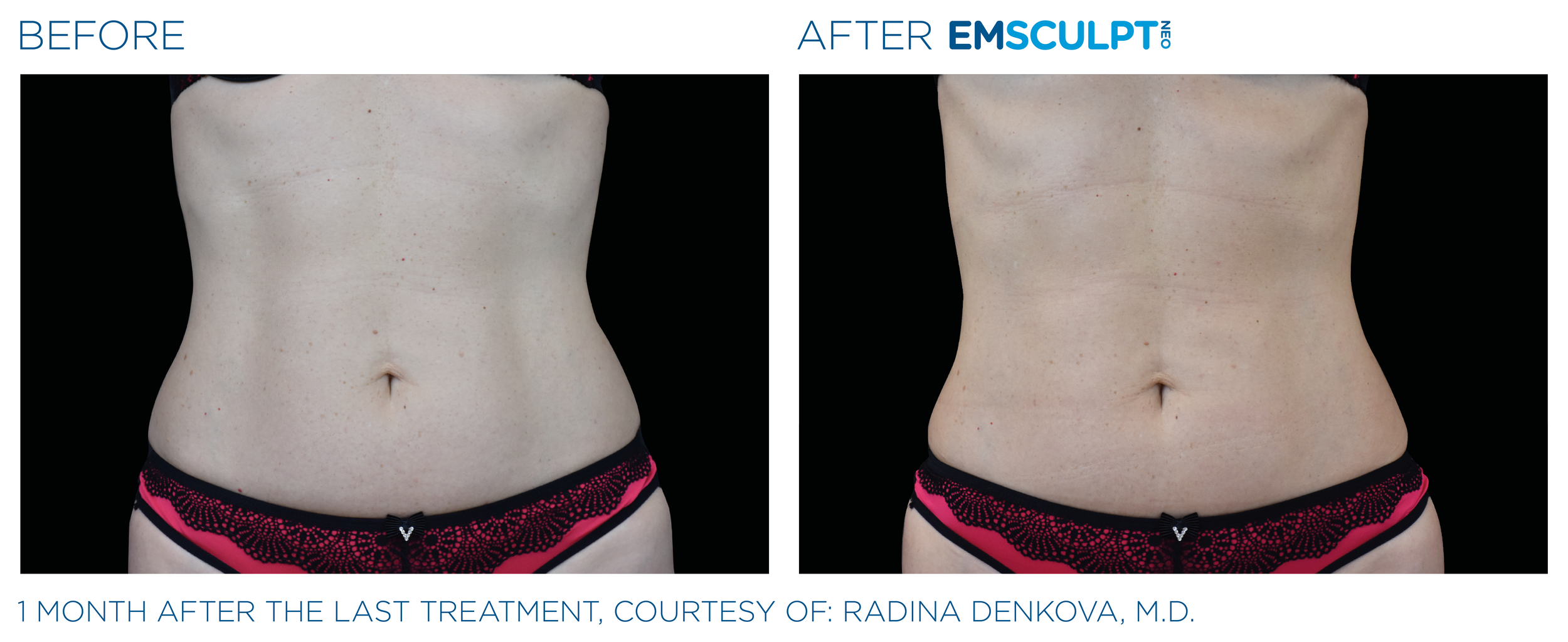 Emsculpt_neo_PIC_Ba-card-female-abdomen-018_ENUS100.png