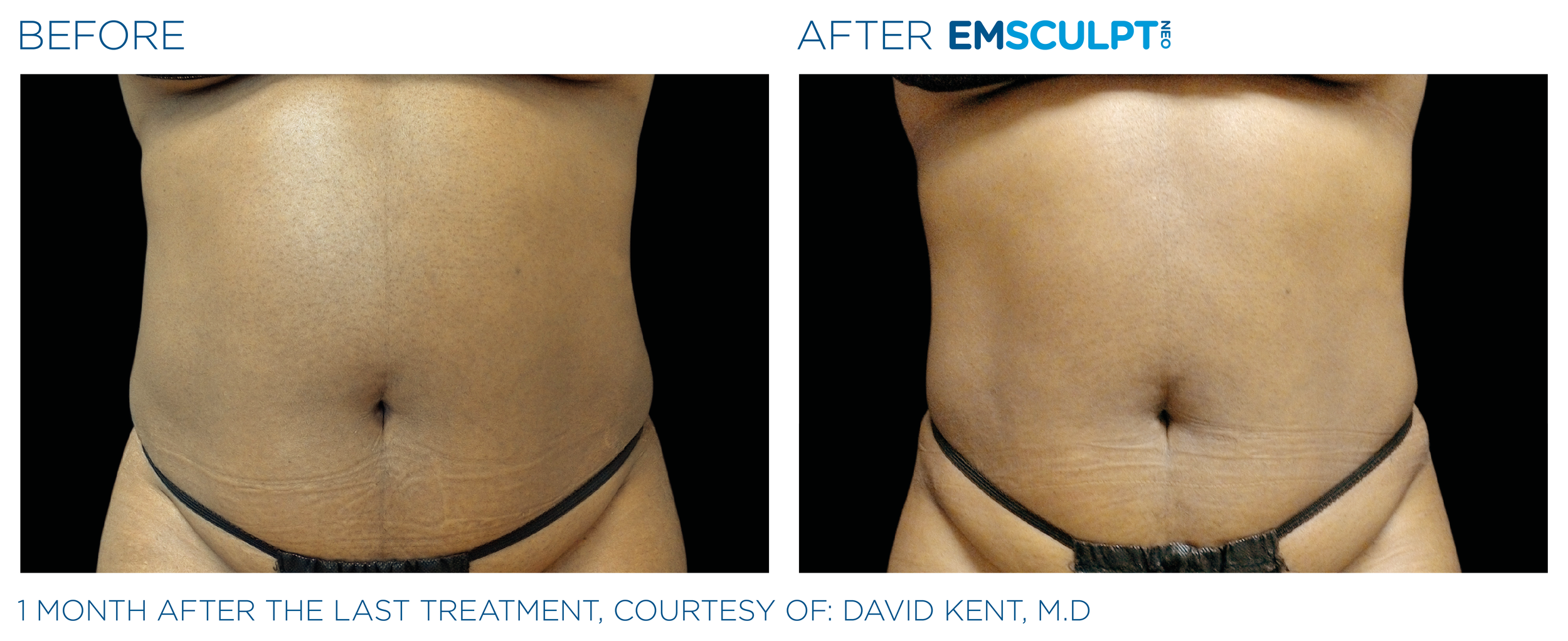 Emsculpt_neo_PIC_Ba-card-female-abdomen-005_ENUS100.png