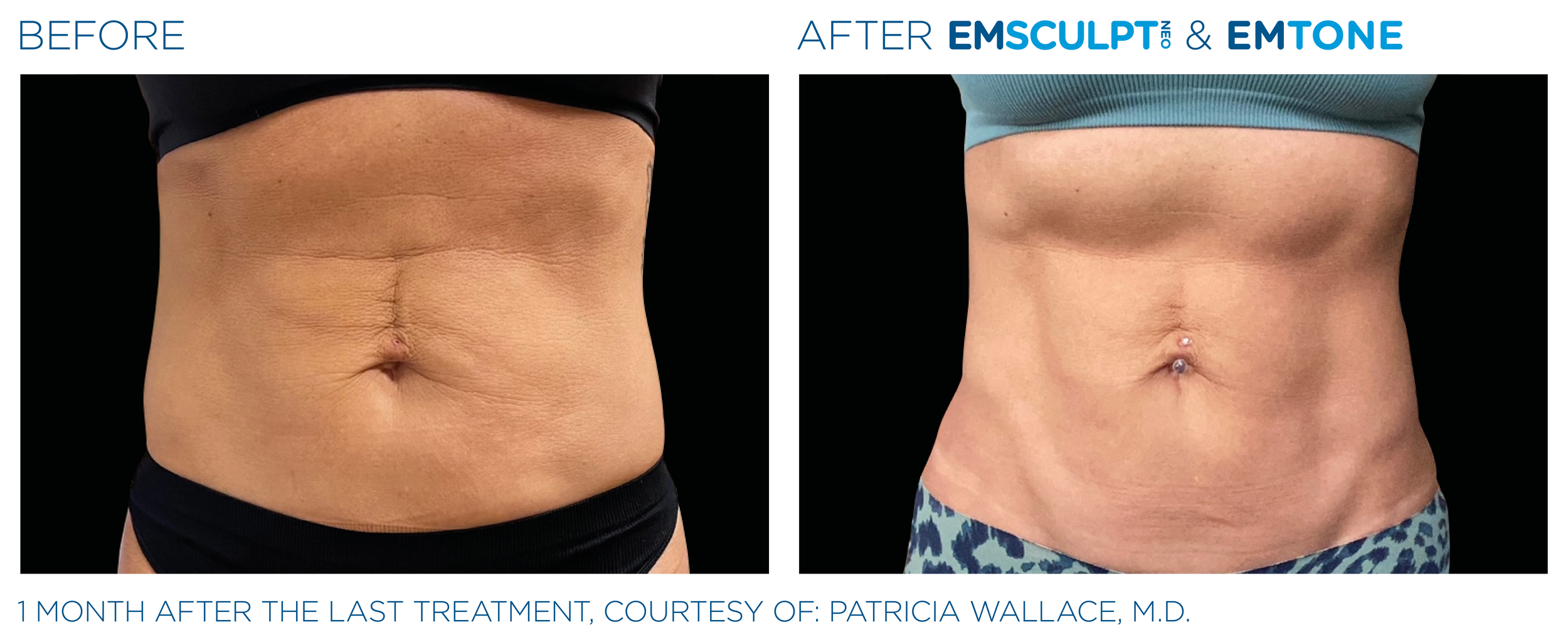 Emsculpt_Neo-Emtone_PIC_Ba-card-female-abdomen-001_ENUS100.png