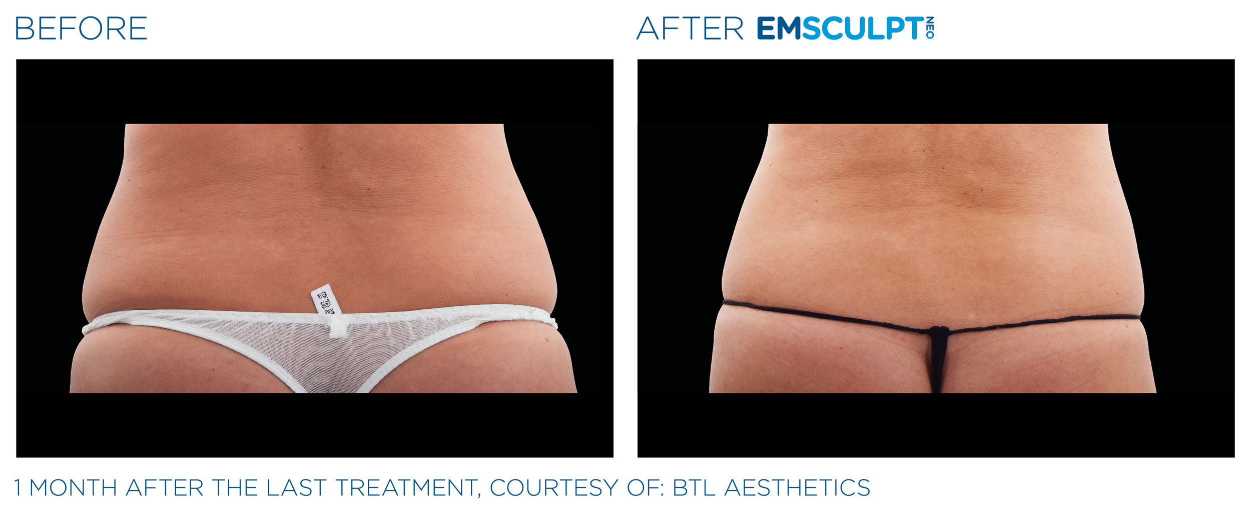 Emsculpt_Neo_PIC_Ba-card-female-lateral-abdomen-113_ENUS100.png