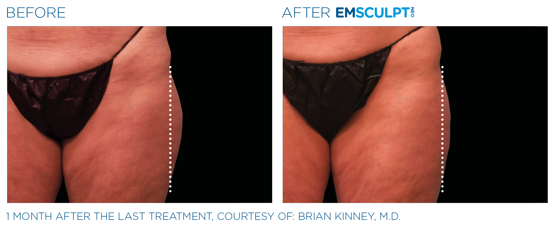 Emsculpt_neo_PIC_Ba-card-female-outer_thighs-049_ENUS100.png