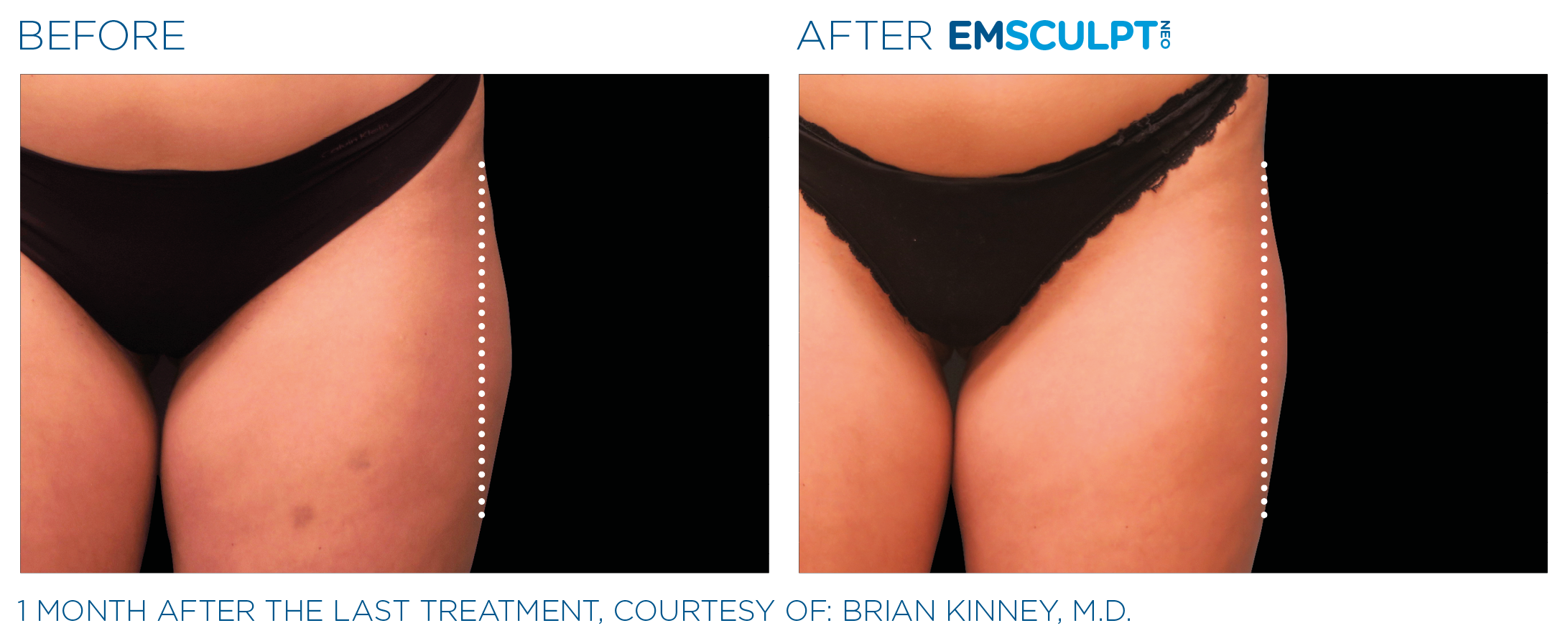Emsculpt_neo_PIC_Ba-card-female-outer_thighs-050_ENUS100.png