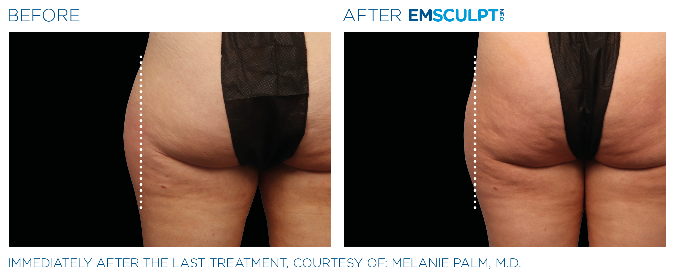 Emsculpt_neo_PIC_Ba-card-female-outer_thighs-053_ENUS100.png