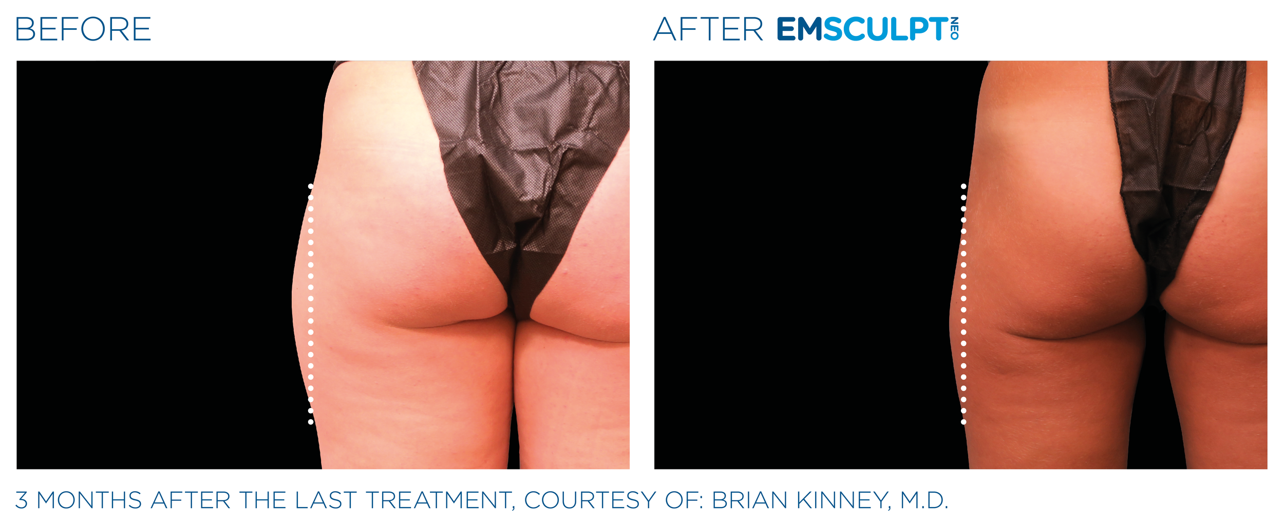 Emsculpt_neo_PIC_Ba-card-female-outer_thighs-094_ENUS100.png