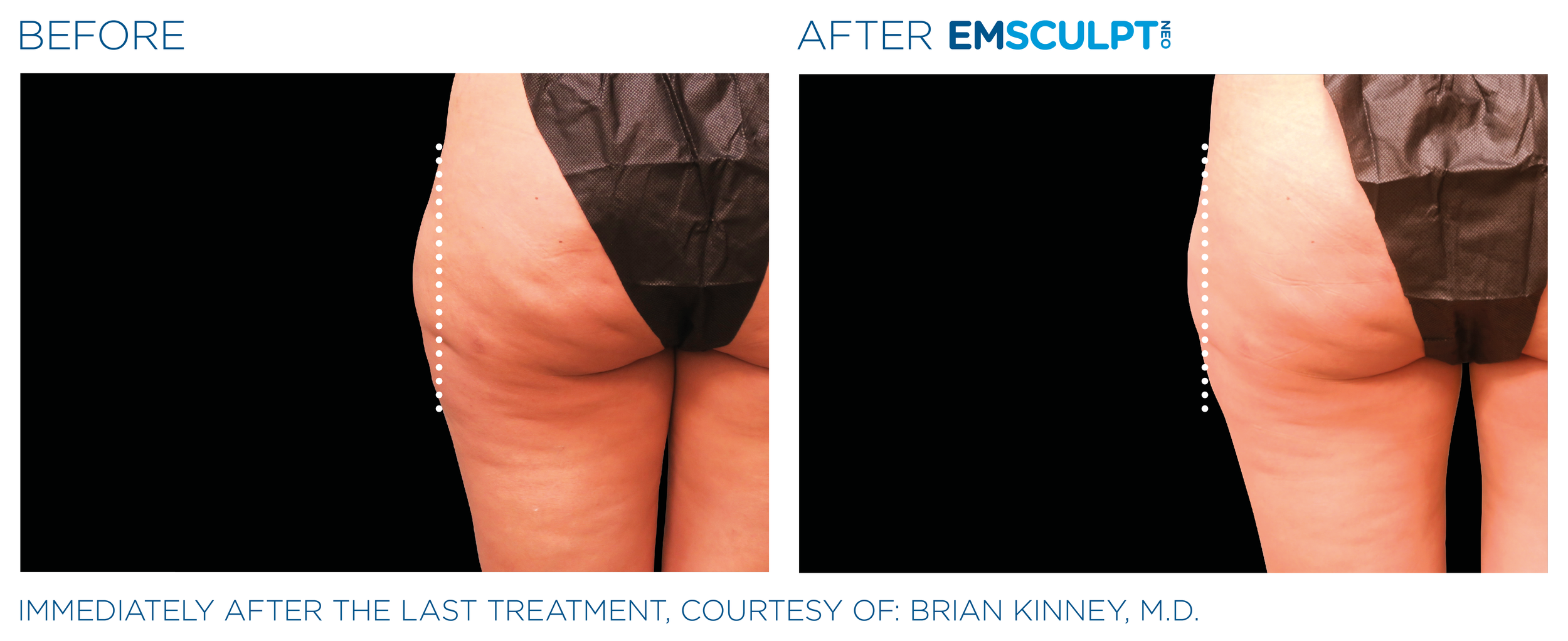 Emsculpt_neo_PIC_Ba-card-female-outer_thighs-092_ENUS100.png