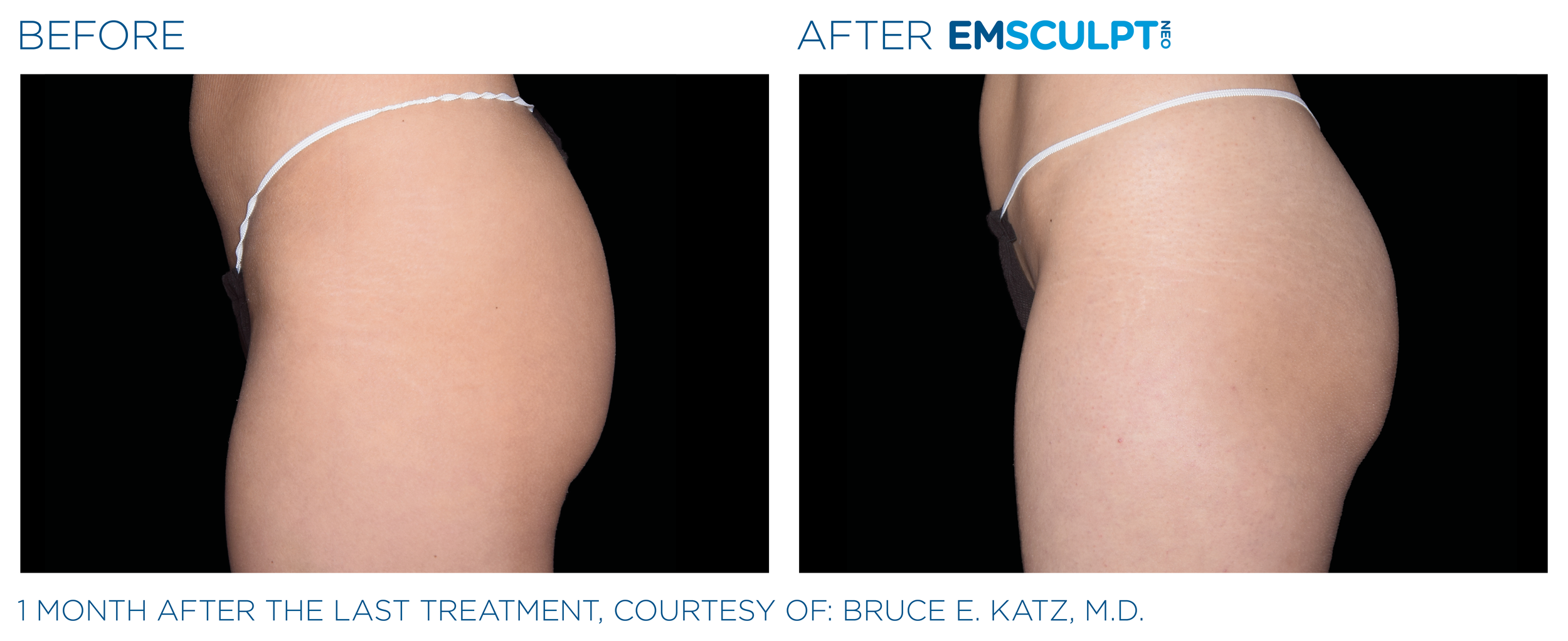 Emsculpt_Neo_PIC_Ba-card-female-buttock-086_ENUS100.png