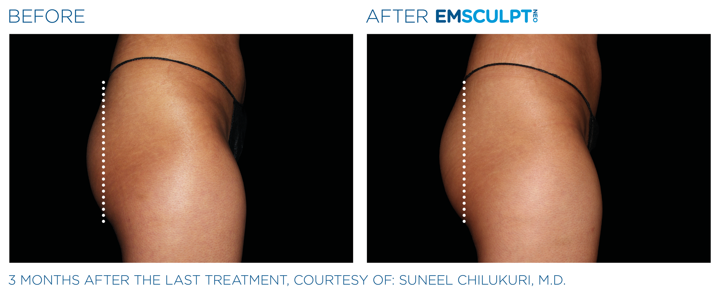 Emsculpt_Neo_PIC_Ba-card-female-buttock-075_ENUS100.png