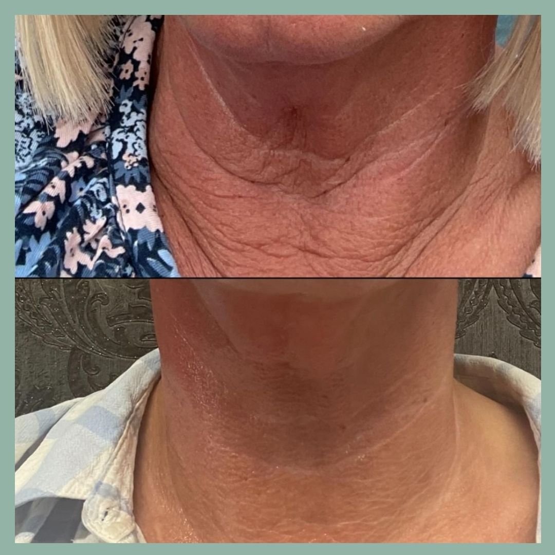 5 treatments - neck.jpg