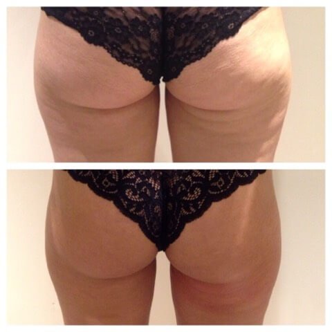 Back-of-Thigh-Toning-Before-After.jpg