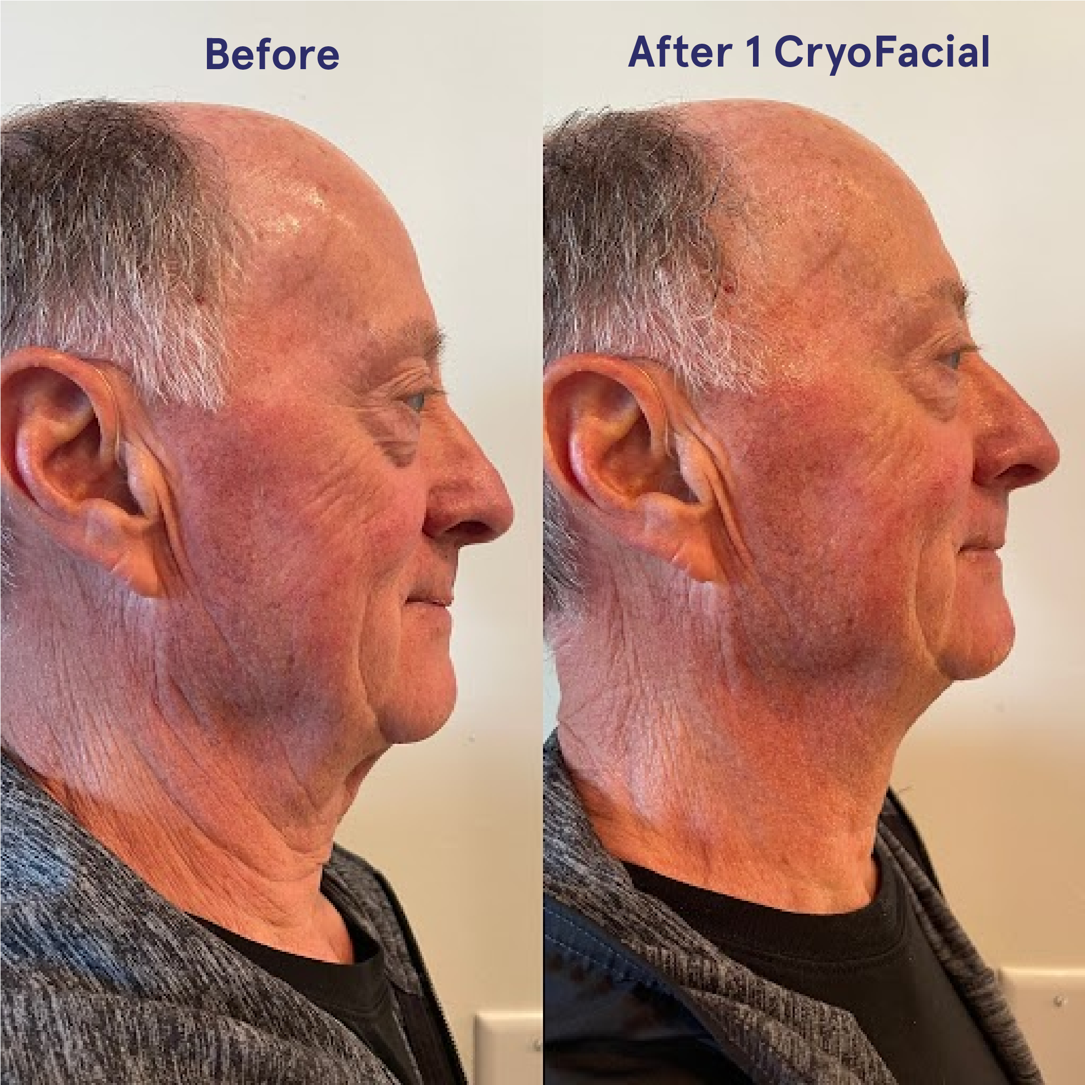 1 CryoFacial treatment.png