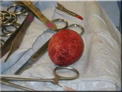 Large Bladder Stone After Removal