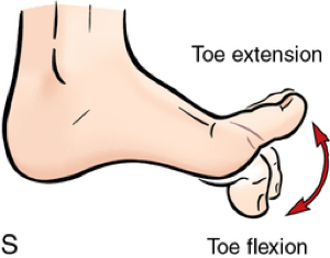 Plantar faciitis2.png