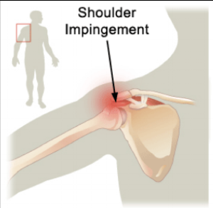 Shoulder Impingement.png
