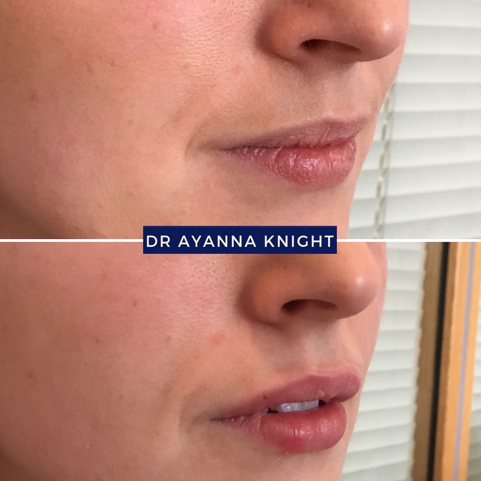 DERMAL FILLER LIP ENHANCEMENT Watermark_08-08-2020_01-00-13pm 2.JPG