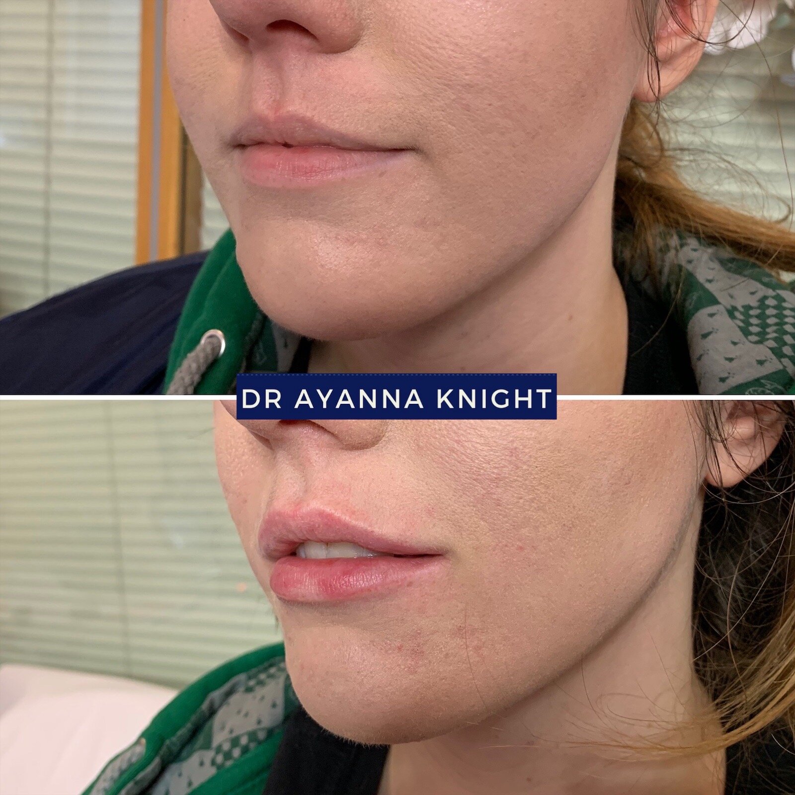 DERMAL FILLER LIP ENHANCEMENT Watermark_08-08-2020_01-11-05pm 2.JPG