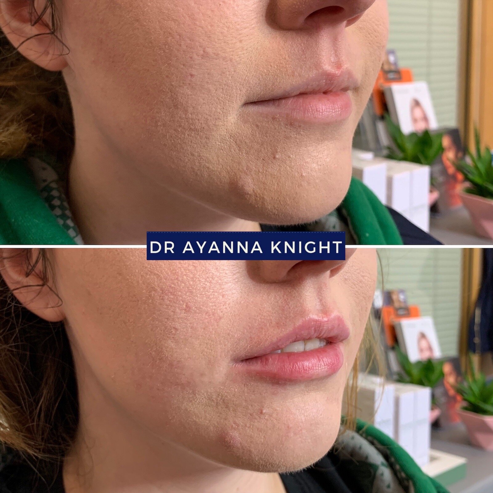 DERMAL FILLER LIP ENHANCEMENT Watermark_08-08-2020_01-11-05pm.JPG