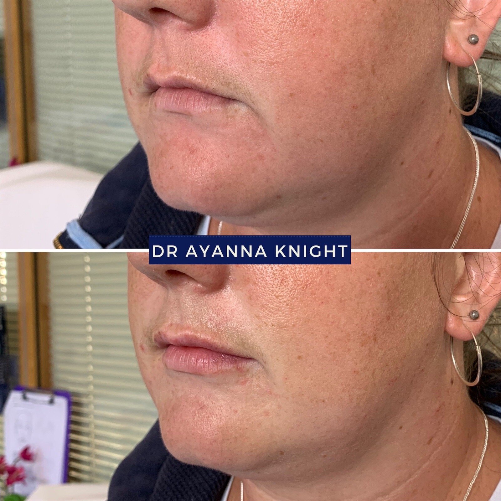 DERMAL FILLER LIP ENHANCEMENT Watermark_08-08-2020_01-11-22pm 2.JPG