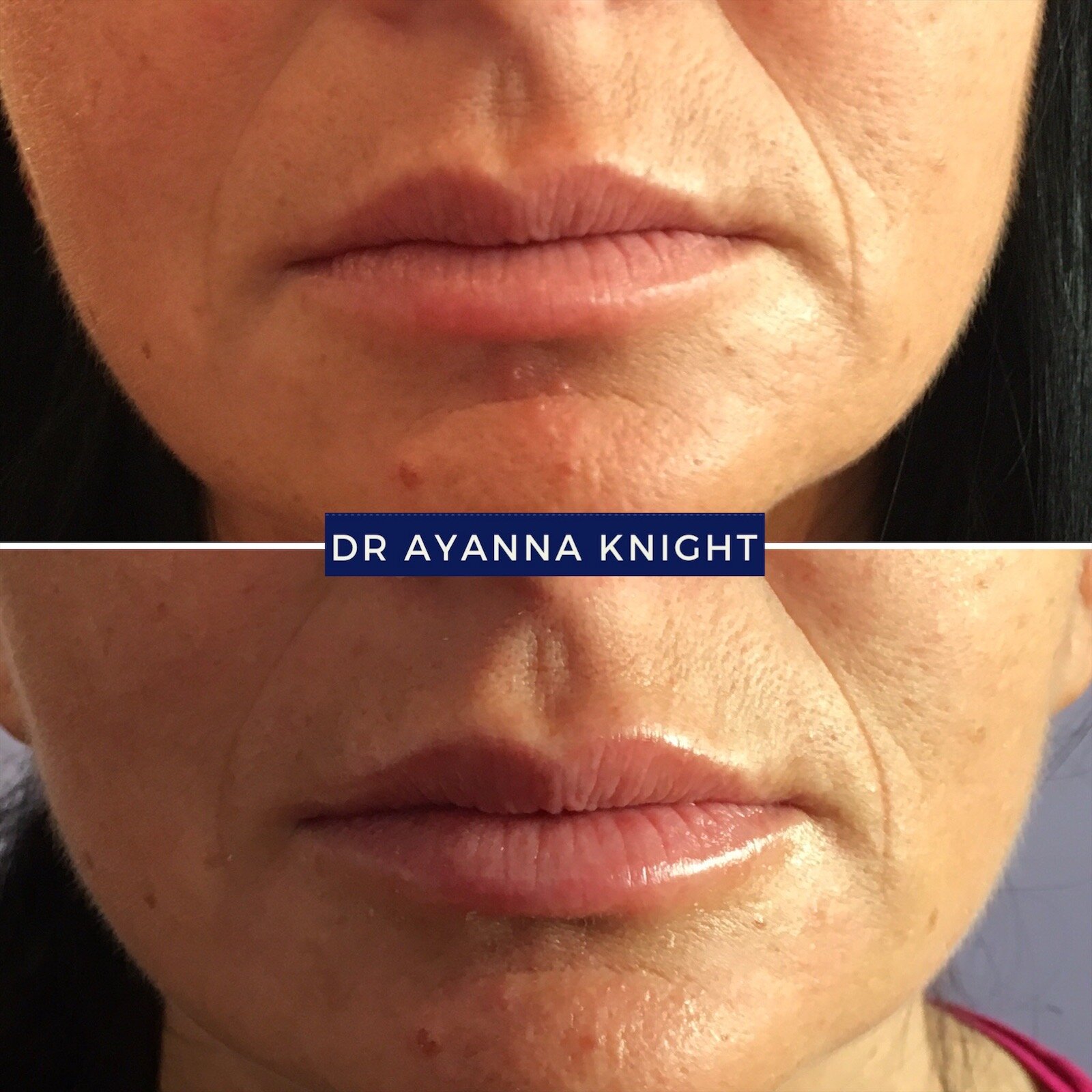 DERMAL FILLER LIP ENHANCEMENT Watermark_08-08-2020_12-55-53pm 2.JPG