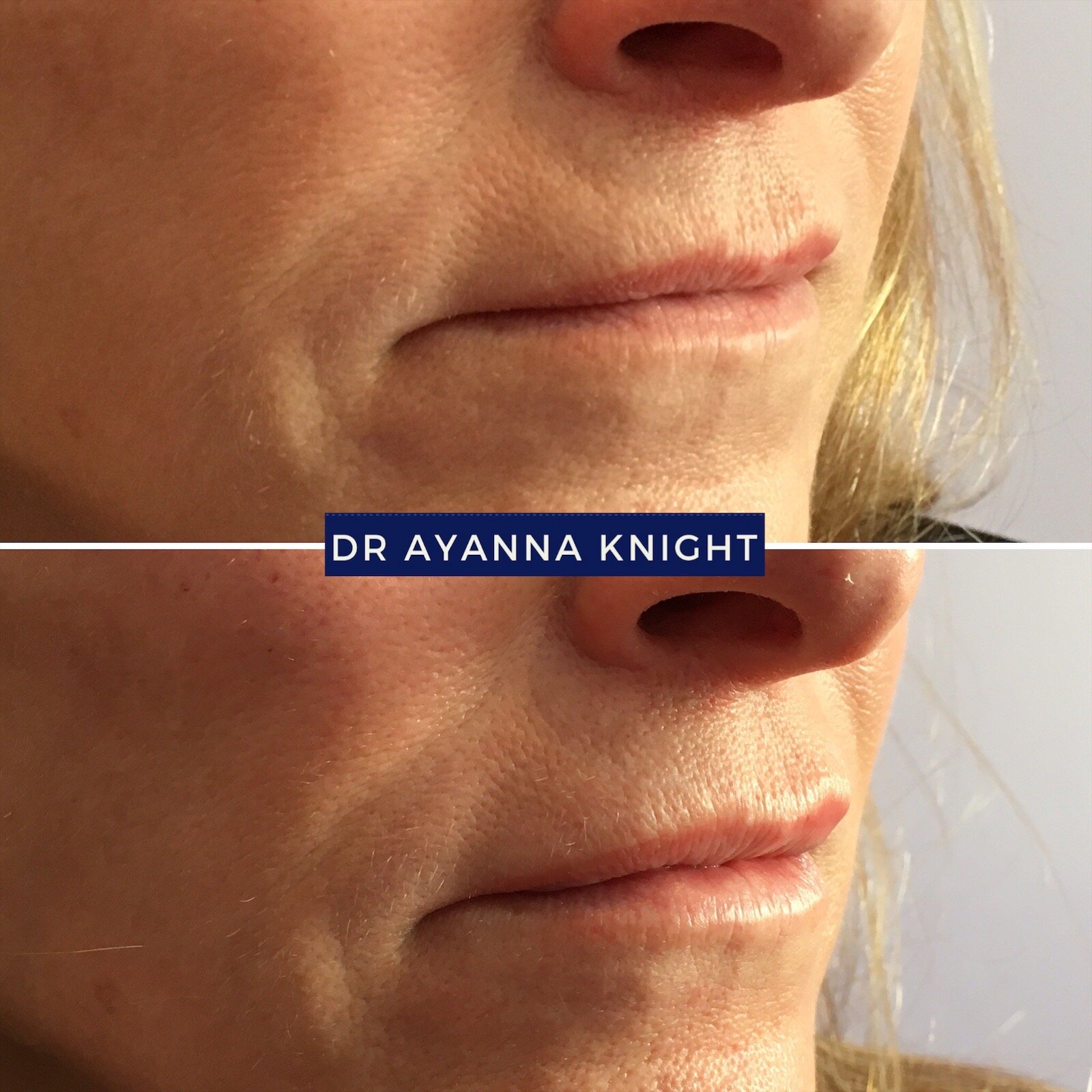 DERMAL FILLER LIP ENHANCEMENT Watermark_08-08-2020_12-56-09pm 3.JPG