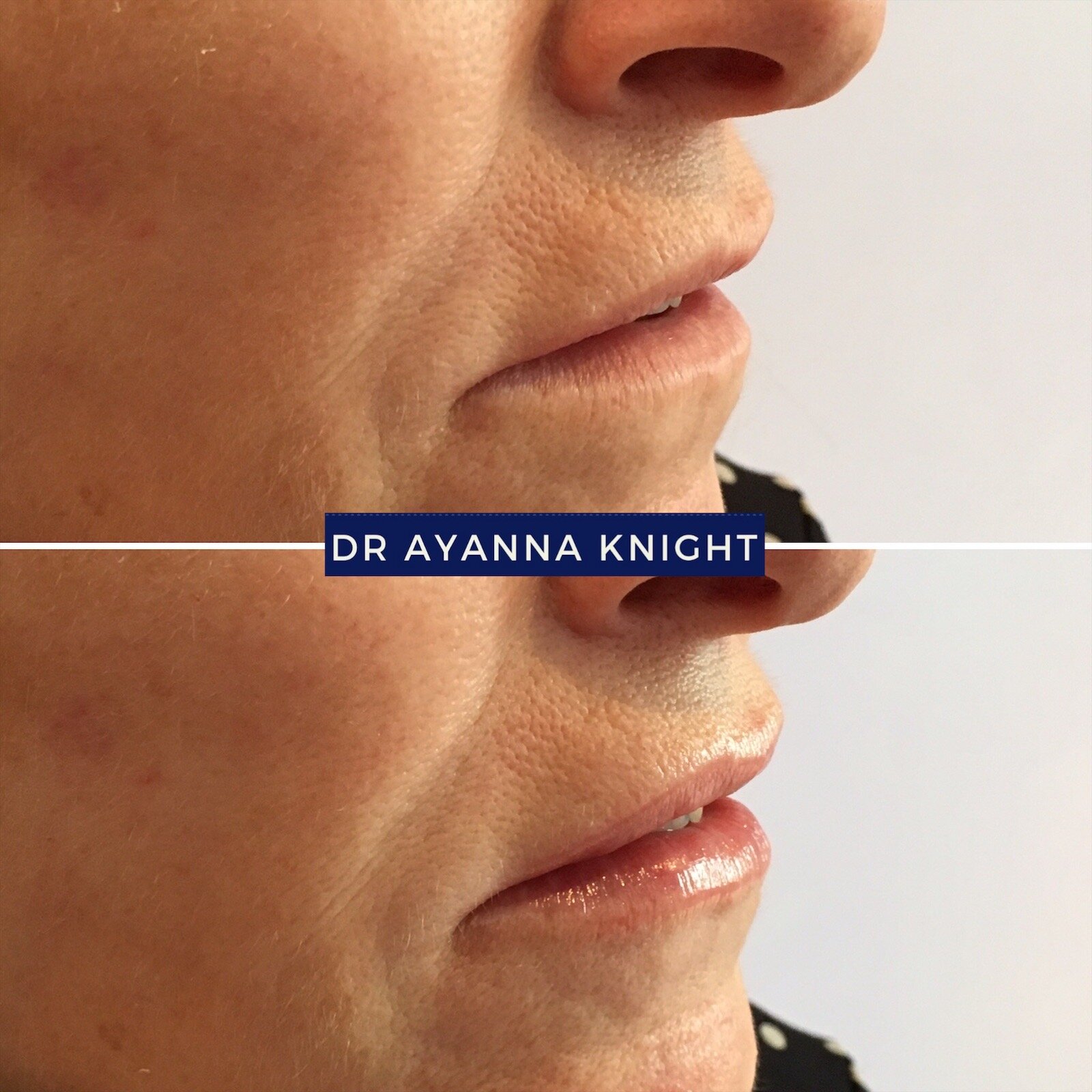 DERMAL FILLER LIP ENHANCEMENTWatermark_08-08-2020_12-58-33pm 2.JPG