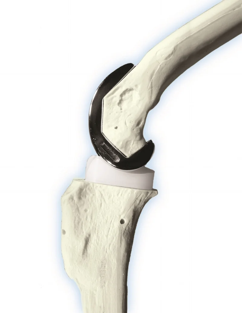 This model illustrates how the new implants fit