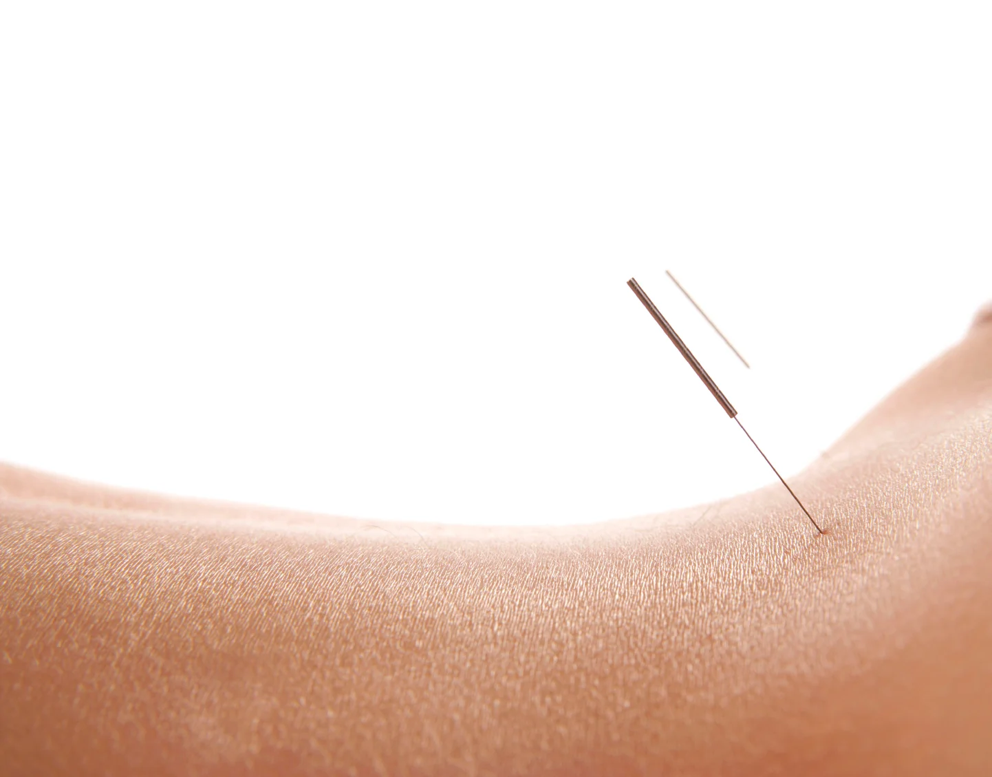 Acupuncture