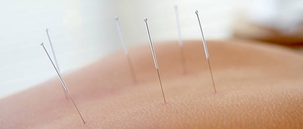 acupuncture