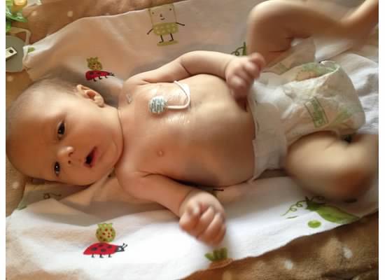 Luka, at home, with his central line broviac for daily IV antibiotics infusions