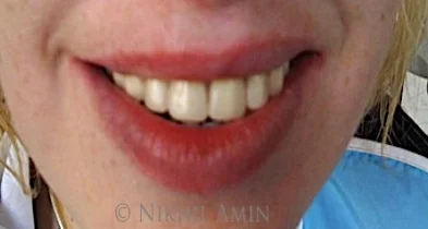 denture 2.jpg