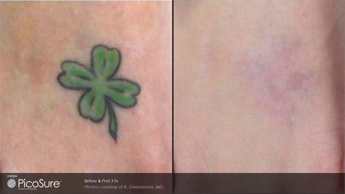 PicoSure Laser Tattoo Removal Adelaide — LaserTat