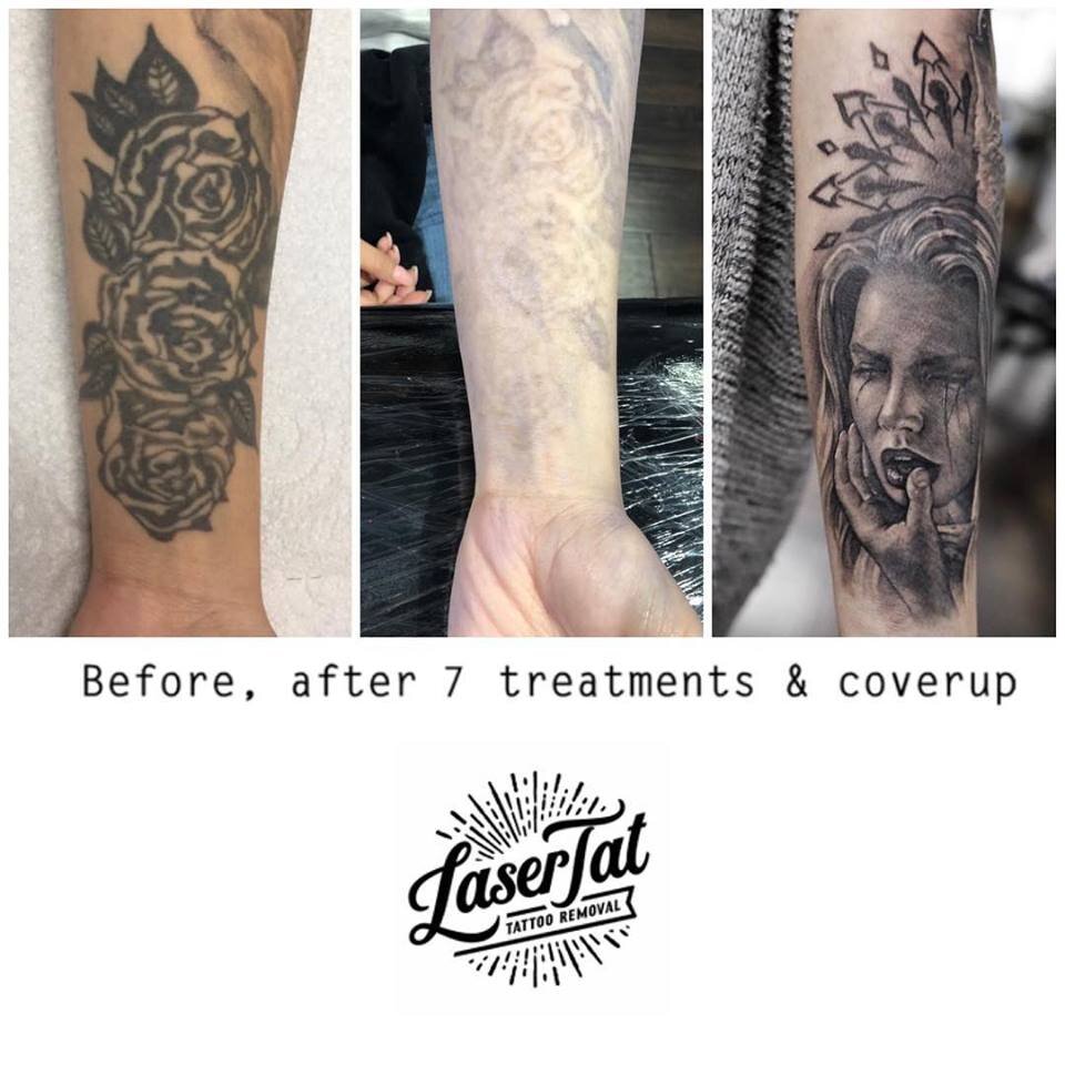 Before & After | Adelaide's Laser Tattoo Removal Experts — LaserTat
