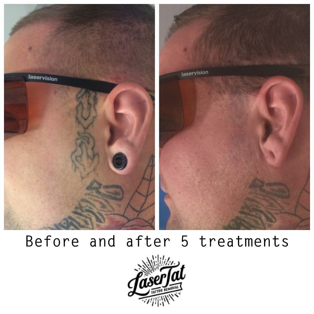 Laser Tattoo Removal Adelaide — LaserTat