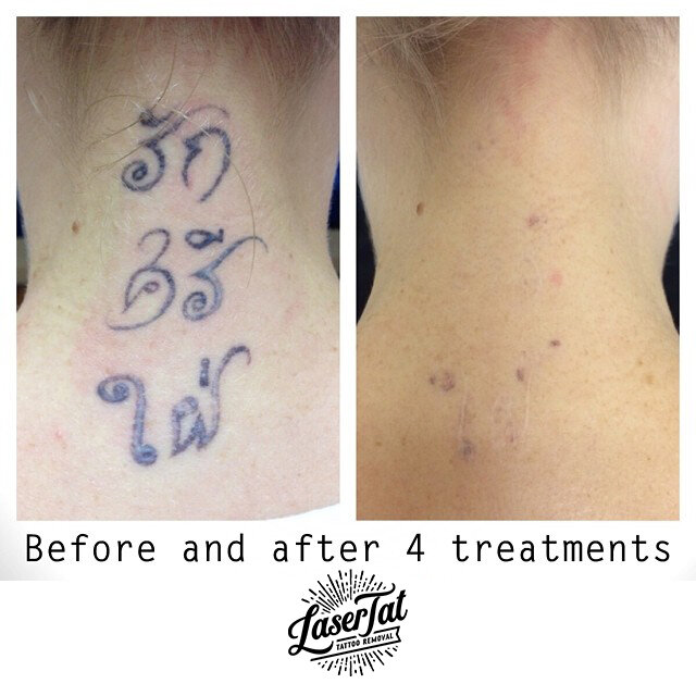 Before & After | Adelaide's Laser Tattoo Removal Experts — LaserTat