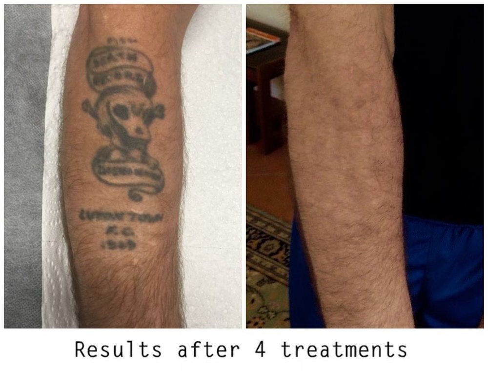 Laser Tattoo Removal Services in Naples FL  239 4315432