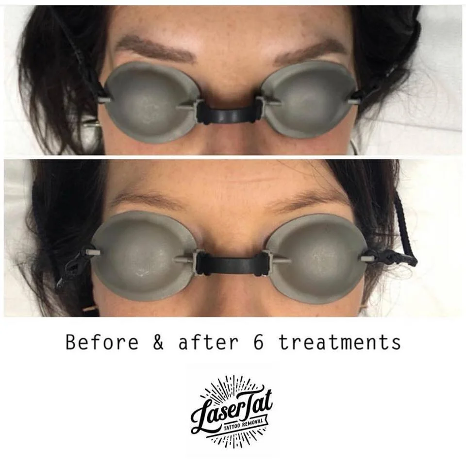 cosmetic-laser-tattoo-removal-1.jpg