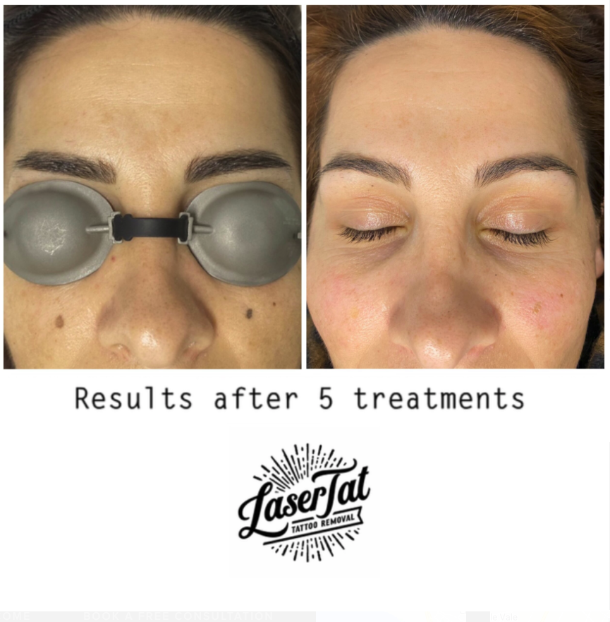 lasertat-cosmetic-laser-tattoo-removal-3.png