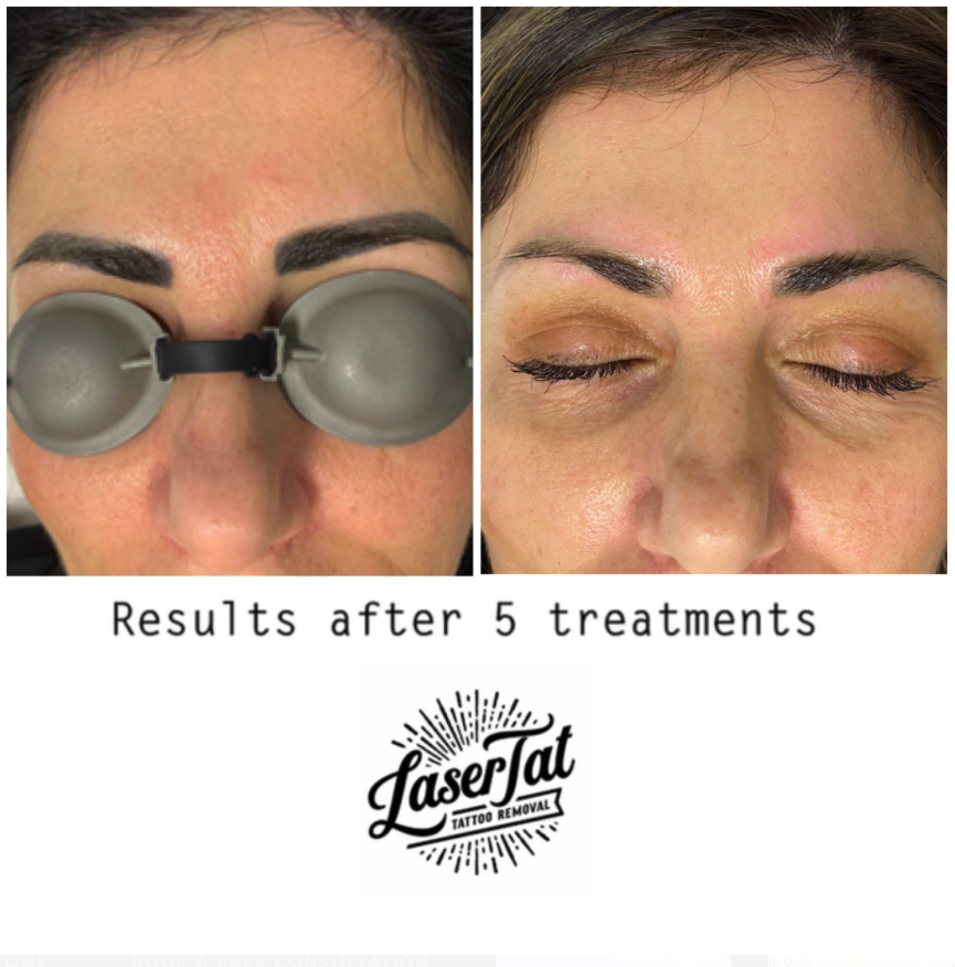 lasertat-cosmetic-laser-tattoo-removal-2.png