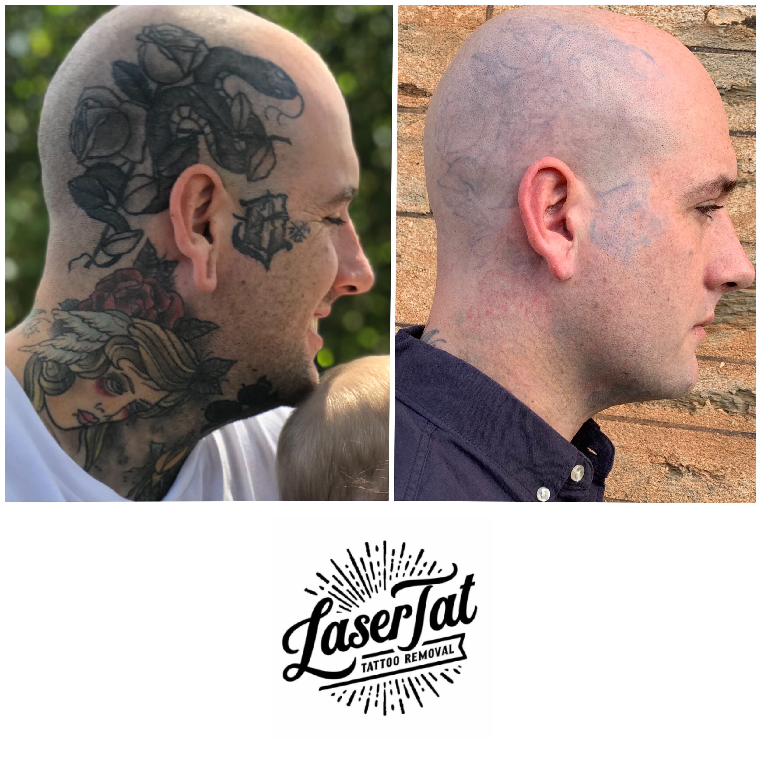 Curt's Journey – Life changing laser tattoo removal — LaserTat