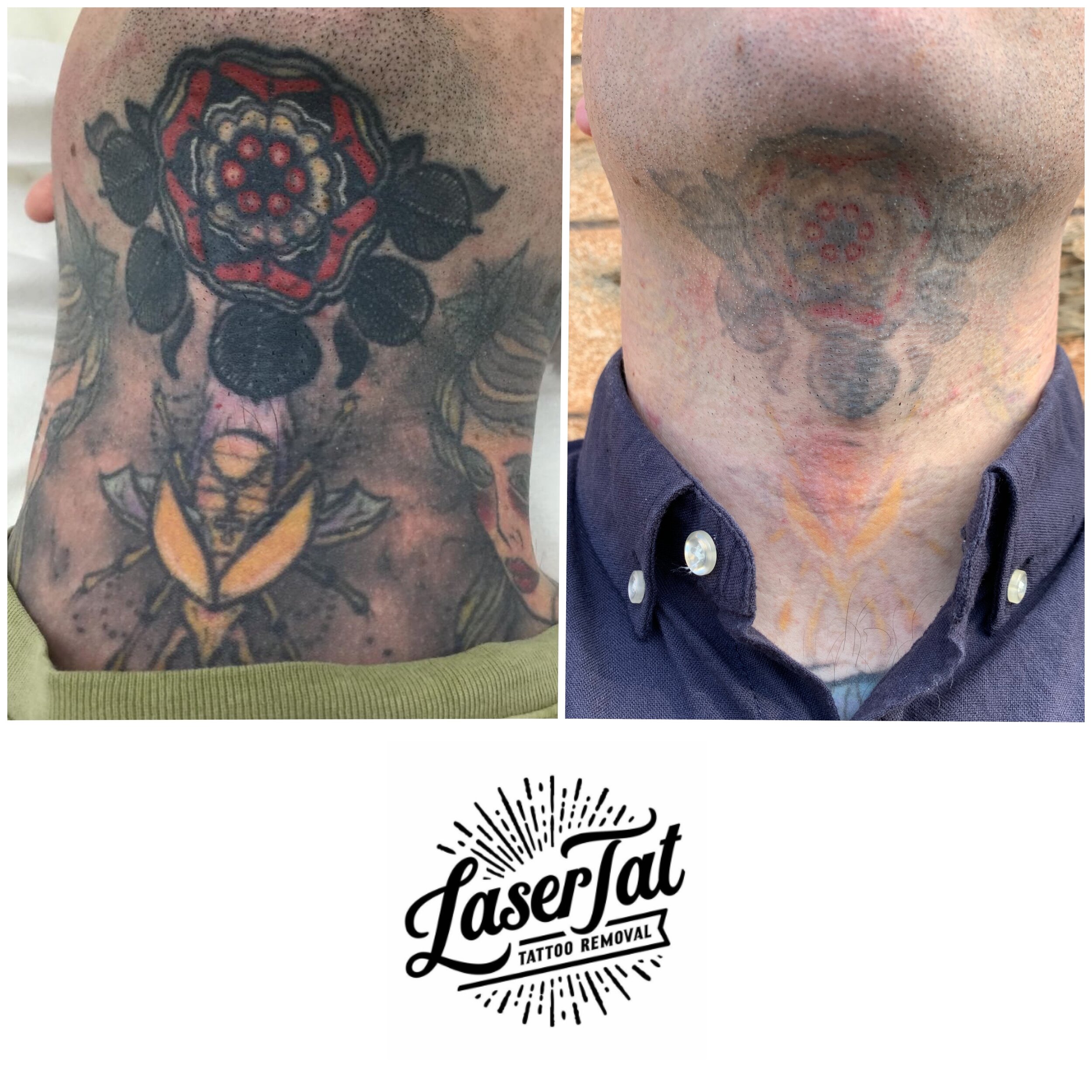 laser tattoo removal adelaide — Adelaide's #1 Laser Tattoo Removal Blog —  LaserTat