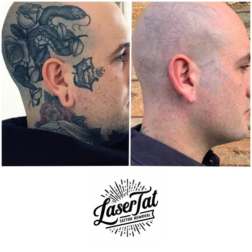 Laser Adelaide S 1 Laser Tattoo Removal Blog Lasertat