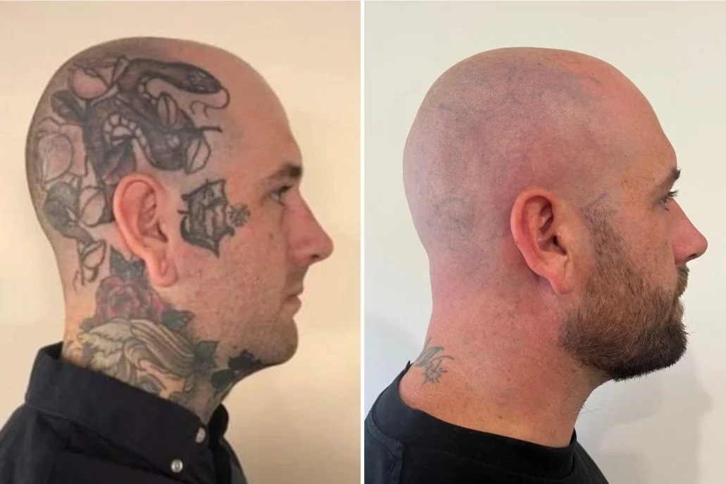 Before and After's: Real Stories Of Laser Tattoo Removal Success — LaserTat