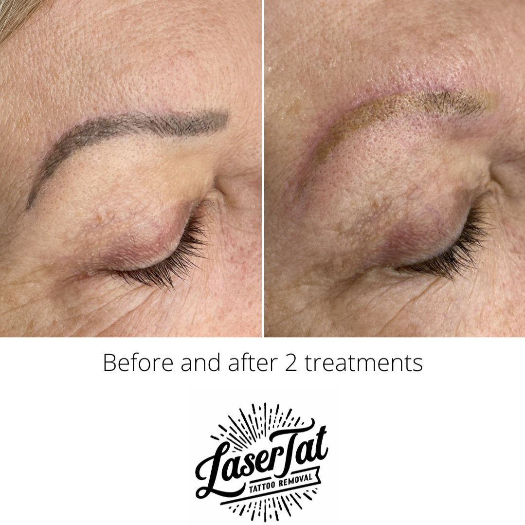 COSMETIC INK - EYEBROW TATTOO REMOVAL