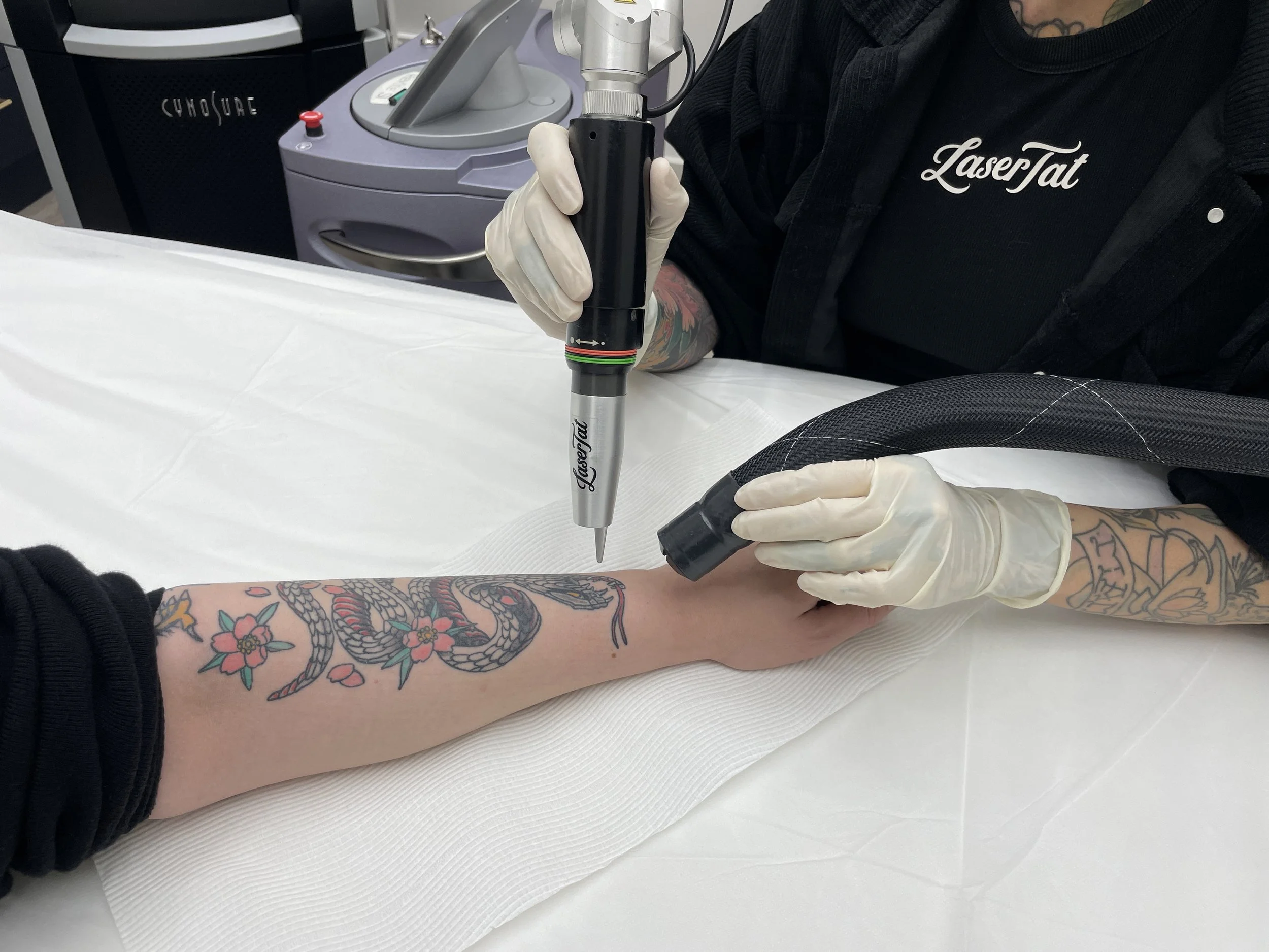 What's the Best Time Of Year to Start Laser Tattoo Removal?