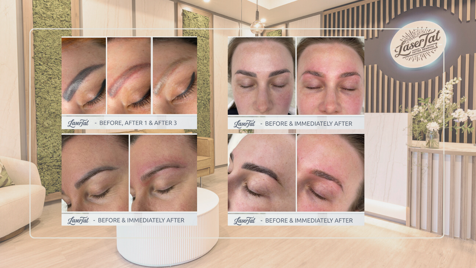 LaserTat's Guide to Cosmetic Eyebrow Tattoo Removal