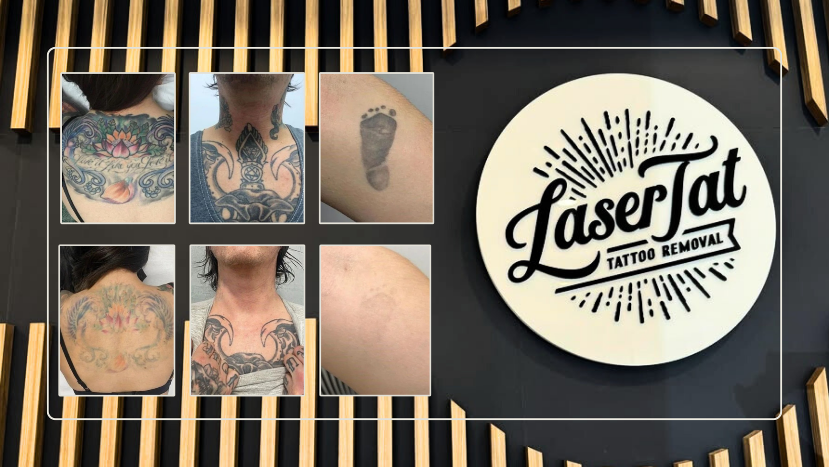Laser Tattoo Removal: How long until you can see results?