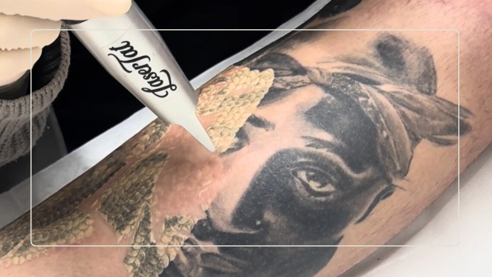 Why are some tattoos easier to remove than others?