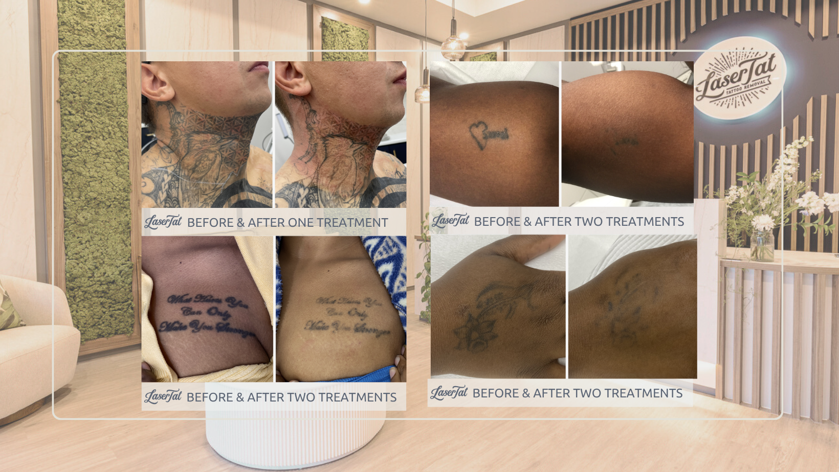 Can I get a tattoo removed if I have dark skin?