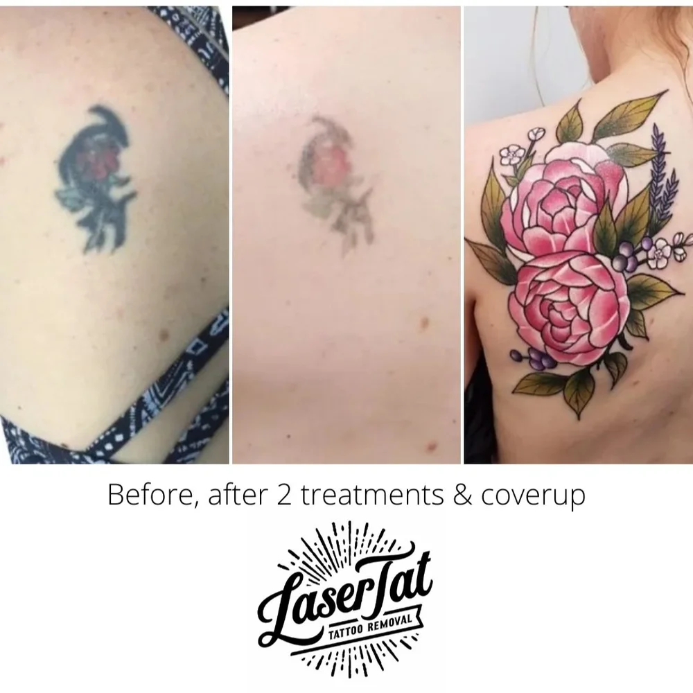 Before and After's: Real Stories Of Laser Tattoo Removal Success — LaserTat