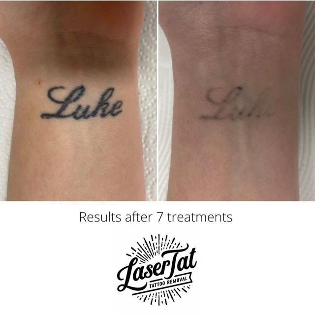 Oops Laser Tattoo Removal  Before and after 2 sessions OOPS always shows  a variety of results to set realistic expectations Results vary from  client to client and tattoo to tattoo We